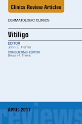 E-book Vitiligo, An Issue Of Dermatologic Clinics