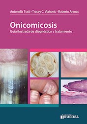 Papel Onicomicosis