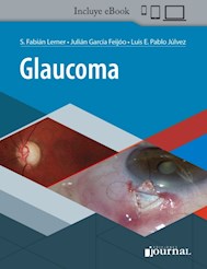 E-Book Glaucoma (Ebook)