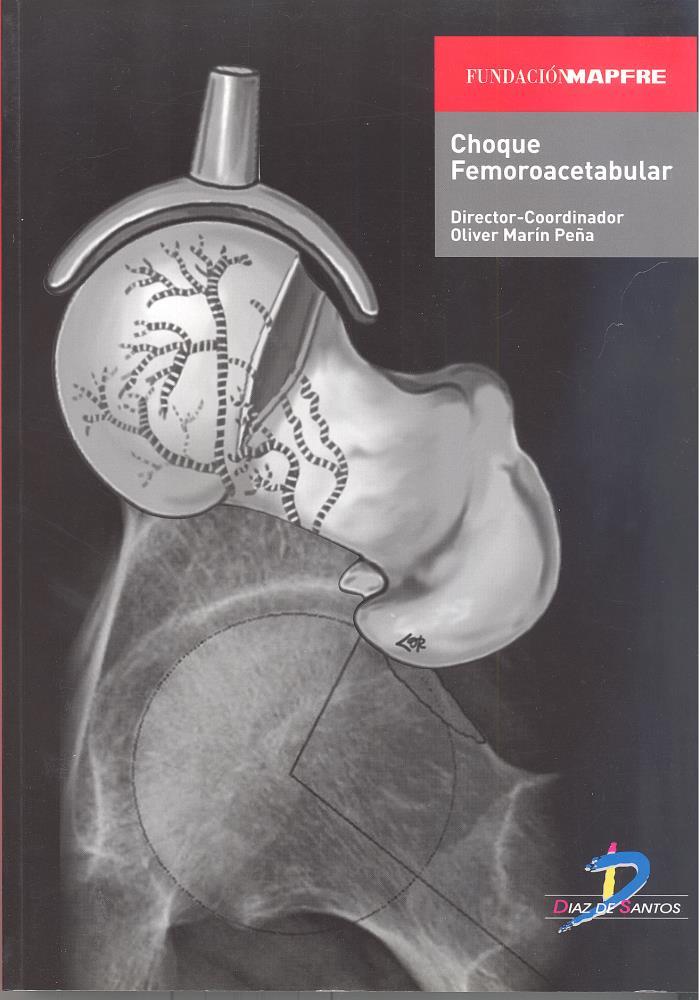 E-book Choque Femoroacetabular